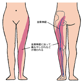 痛みの原因となる坐骨神経って どこにあるの 坐骨神経痛 毎日が発見ネット