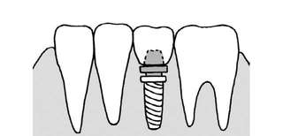 インプラント、ブリッジ、部分入れ歯。「3種類の義歯」の違いを和田淳一郎先生が解説