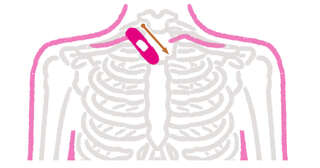 【絆創膏を貼るだけ】「五十肩」の痛みの原因にアプローチする方法