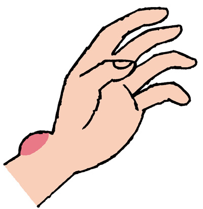 「夜間や明け方にしびれが強くなる」...その手指の痛み、腫れ、しびれはこんな病気！／手指の痛み改善法（2） 005.jpg