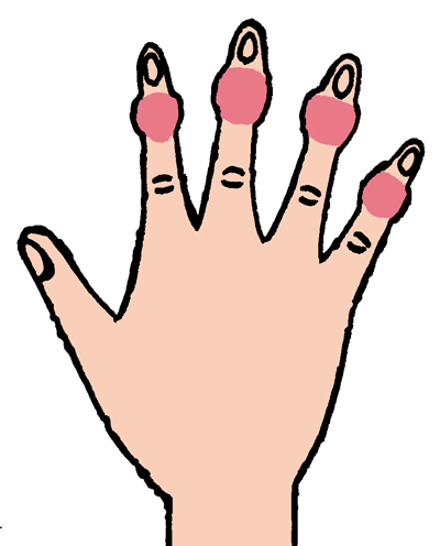 手の指の第一関節、第二関節、親指の付け根が、腫れる、曲がる、痛むは要注意！／手指の痛み改善法（3） 007.jpg