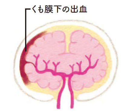 脳閉塞以外にも「くも膜下出血」や「脳出血」も！ 知っておきたい「脳卒中」のこと 051kumo.jpg