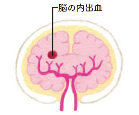 脳閉塞以外にも「くも膜下出血」や「脳出血」も！ 知っておきたい「脳卒中」のこと 051naisyukketu.jpg