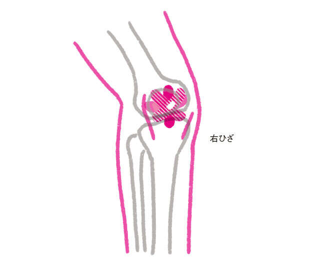 【ひざ痛の原因と対策】「絆創膏」でインナーマッスルにアプローチ！ 0903.jpg