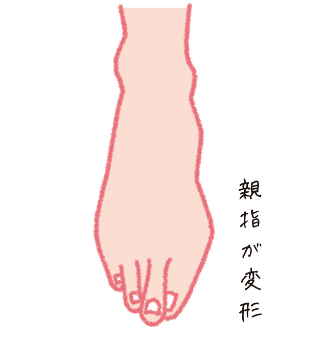 浮き指、浮き上げ指、タコ・うおのめ。女性に多い足の不調／足指力を鍛える（６） 1801p62_03.jpg