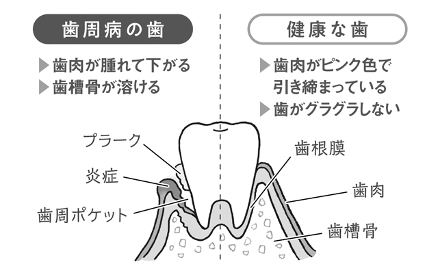 歯周病は日本人の「歯を失う理由」第１位！　その原因は？／歯周病（１） 1802p089_01.jpg