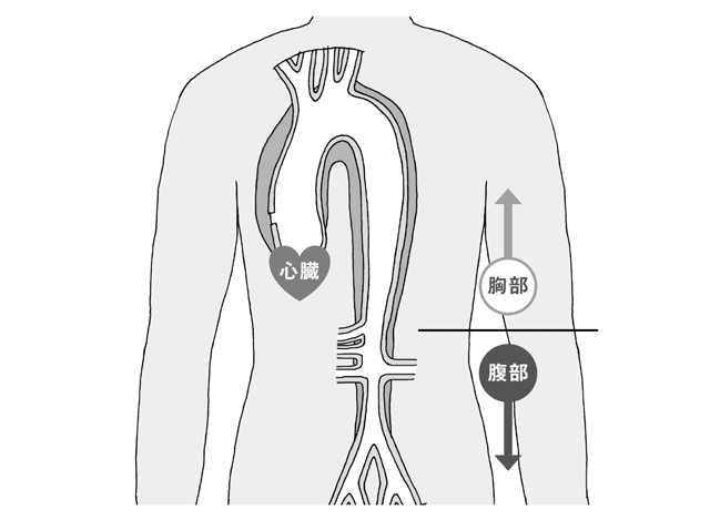「大動脈解離」になると、血管はこのように変化していく 1804p085_01.jpg