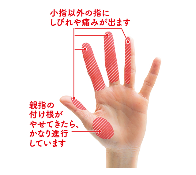 親指の付け根がやせていませんか 女性に多い 手根管症候群 に注意 毎日が発見ネット
