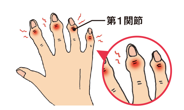 更年期以降の女性に多い！「6つの手指の病気」とは 2001p056_04.jpg