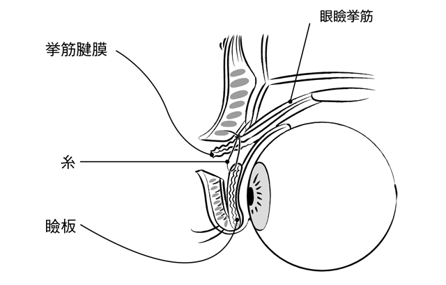 日帰り手術も可能です。まぶたが垂れ下がる「眼瞼下垂」の治療法 2003p091_04.jpg