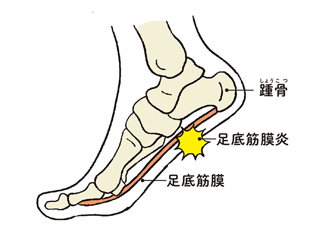 片足で立てない 足が冷える それは足裏の筋力が弱っているかも 症状をチェック 毎日が発見ネット