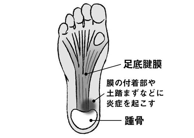 最初の一歩目に足裏が強く痛む「足底腱膜炎」。主な要因と対処法は？ 2201_P090_01.jpg
