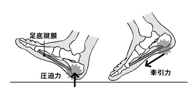 最初の一歩目に足裏が強く痛む「足底腱膜炎」。主な要因と対処法は？ 2201_P090_02.jpg