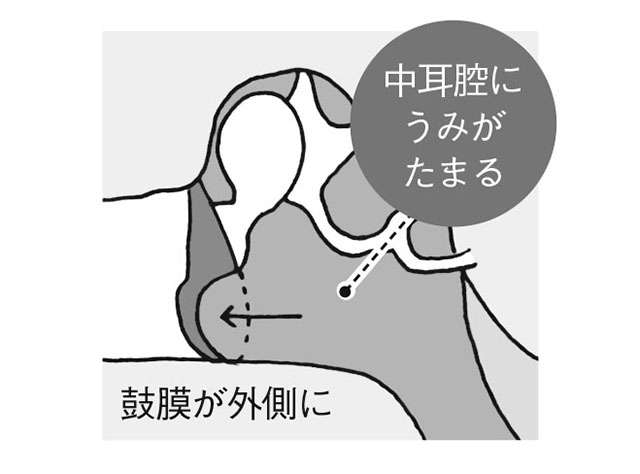 大人でもなる「中耳炎」セルフチェック！ 「難聴」と間違われやすいので要注意 2204_P079_02.jpg