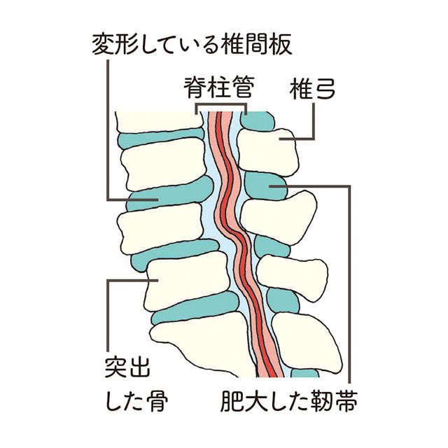 あらゆる腰痛の行きつく先「脊柱管狭窄症」。なりやすい人の特徴とは 2211_P035_02.jpg
