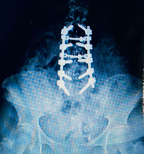 あらゆる腰痛の行きつく先「脊柱管狭窄症」。なりやすい人の特徴とは 2211_P035_03_W500.jpg