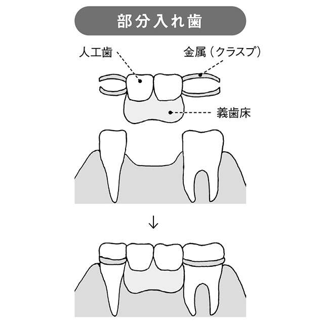 失った歯の代わりはどうする？ 自分にあった義歯の選び方【和田淳一郎先生が解説】 2402_P071_02.jpg