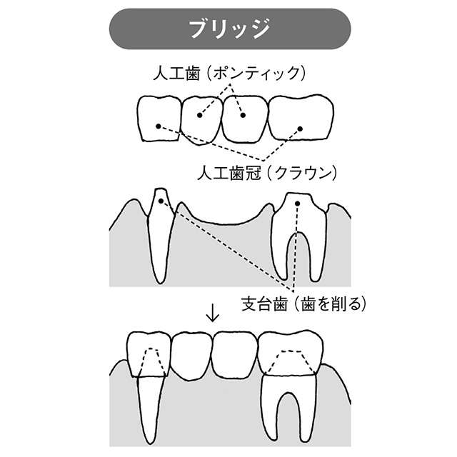 失った歯の代わりはどうする？ 自分にあった義歯の選び方【和田淳一郎先生が解説】 2402_P071_03.jpg