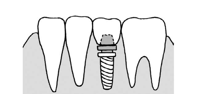 インプラント、ブリッジ、部分入れ歯。「3種類の義歯」の違いを和田淳一郎先生が解説