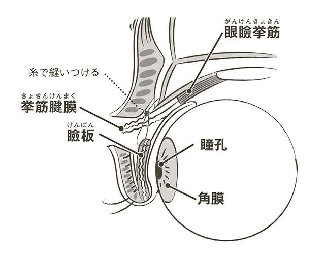 目が開けにくい、視野が狭い...上まぶたが下がる「眼瞼下垂」を医師の村上正洋先生が解説 2403_P074-075_06.jpg