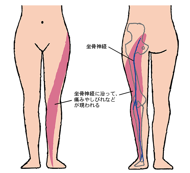 痛みの原因となる坐骨神経って、どこにあるの？／坐骨神経痛 zakotsushinkeitsuu.jpg