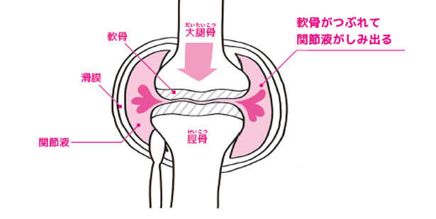 【ひざの寿命を延ばす！】ひざの痛みと変形を防ぐために「軟骨を守る」方法 0102.jpg