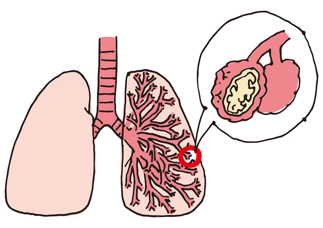長引くと厄介。肺のガス交換室が炎症を起こす「間質性肺炎」／やさしい家庭の医学