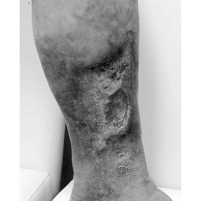 足の皮膚が真っ黒に...!?「下肢静脈瘤」を放置すると危険がたくさん 荳玖い髱呵ц逖､_逕ｻ蜒・kashi_P093_04.jpg