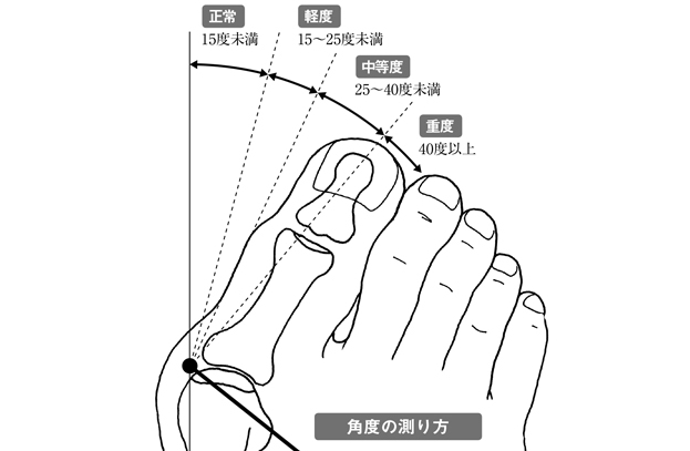 あなたの「重症度」をチェックしてみて。「外反母趾」の基礎知識