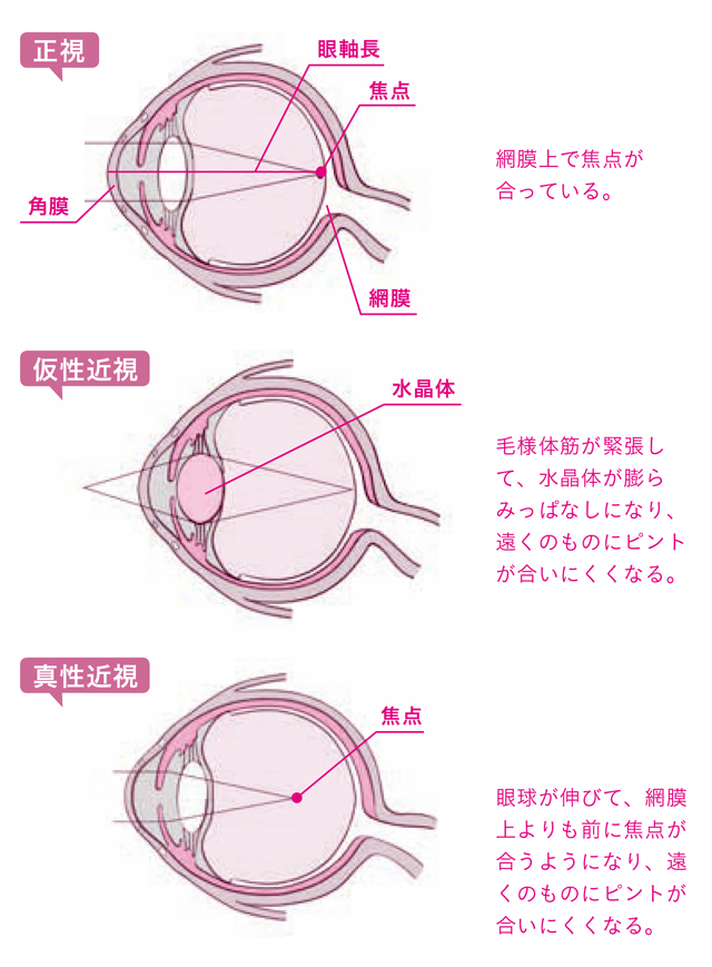 日本人のなんと6割が近視。どうして近視になるの？／「ツボ押し」で目の不調を解消 逕ｻ蜒柔逶ｮ縺ｮ繝・・繧・menotsubo_P28.jpg