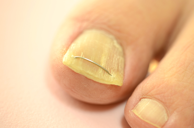 ｢陥入爪｣は間違った爪の切り方が一番の原因／足の爪の変形