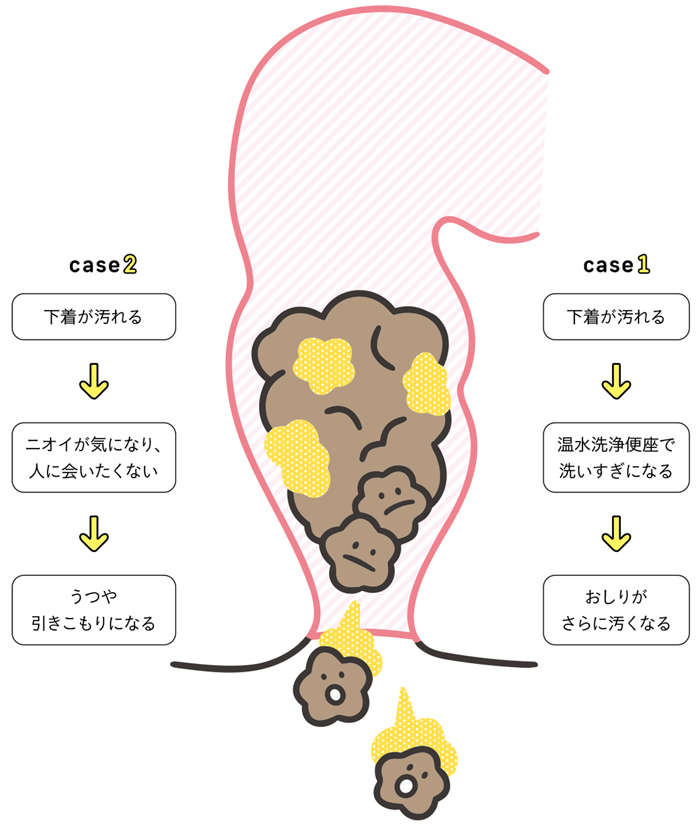 おなかがゆるい、下痢をくり返す。実はこれも「便秘」!? 汗や口のニオイにも関係する「出口の便秘」 ニセ便失禁による負の連鎖