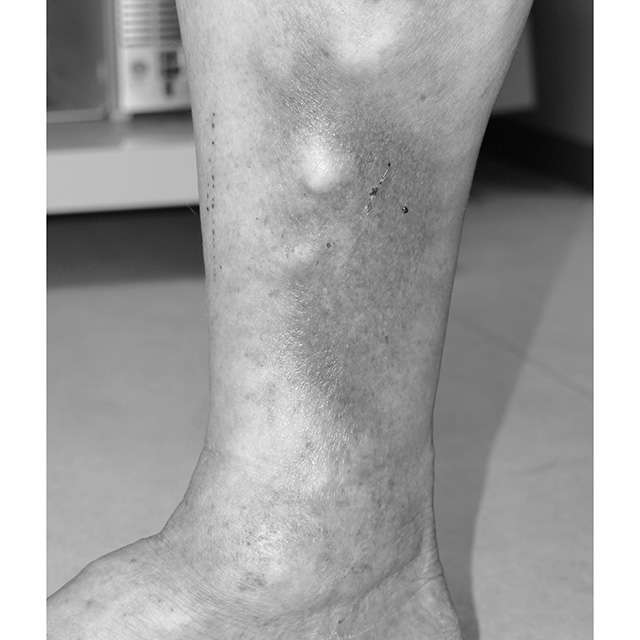 足の皮膚が真っ黒に...!?「下肢静脈瘤」を放置すると危険がたくさん 荳玖い髱呵ц逖､_逕ｻ蜒・kashi_P093_03.jpg