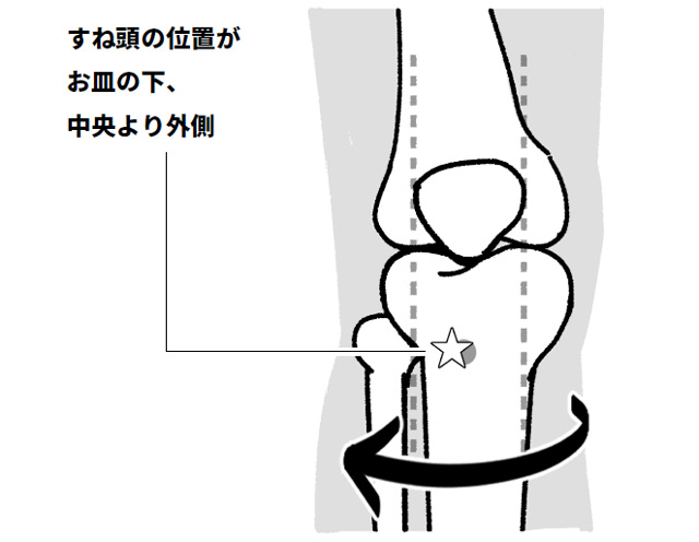 ねじれが強いほど「ひざ」が痛くなる･･･ひざ痛の原因の一つ「足のねじれ」のチェック法