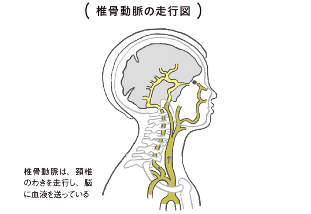 首の骨を鳴らす「首ポキ」が危険な理由。厚生労働省が警鐘を鳴らす「椎骨動脈解離」の発生リスク igakulifehack04_01.jpg