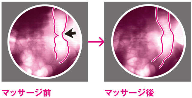 「腸ゆらしマッサージ」で便秘解消！手順とポイントを便秘外来医が解説 kaibei00401.jpg