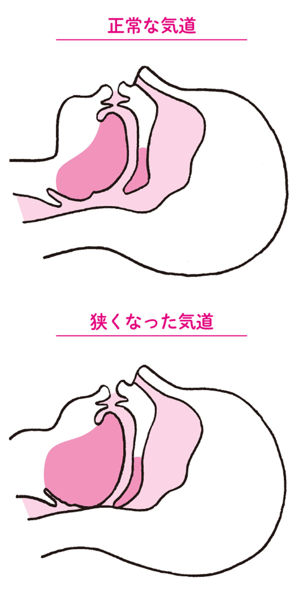 女性の「いびき」のきっかけは閉経が多。女性ホルモンと「舌力」、いびきの関係【チェックリストあり】 shitakoso111.jpg