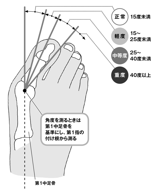 意識しないと外反母趾は重症化する／ご存じですか？外反母趾（２） zu_gaihanboshi2.jpg