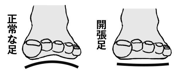 サンダル履きは要注意！外反母趾を悪化させないポイントは／ご存じですか？外反母趾（３） zu_gaihanboshi3-1.jpg