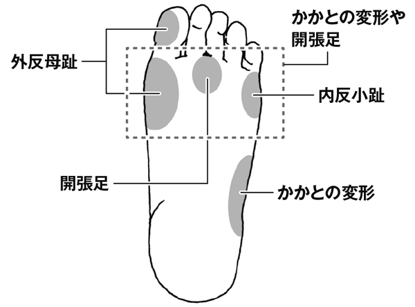 サンダル履きは要注意！外反母趾を悪化させないポイントは／ご存じですか？外反母趾（３） zu_gaihanboshi3-2.jpg
