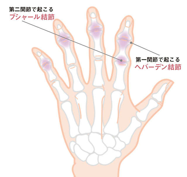 セルフチェックで手指の病気を自己診断！ あなたはどこに痛みを感じますか? P039_01.jpg