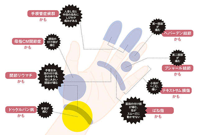 セルフチェックで手指の病気を自己診断！ あなたはどこに痛みを感じますか? P036-037_01.jpg