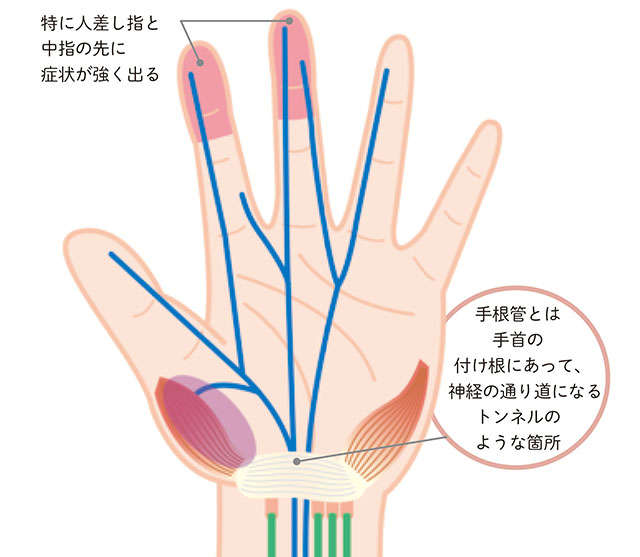 手指が痛む...おもな症状と特徴をチェックして、あなたの「病気」を特定しよう P047_01.jpg