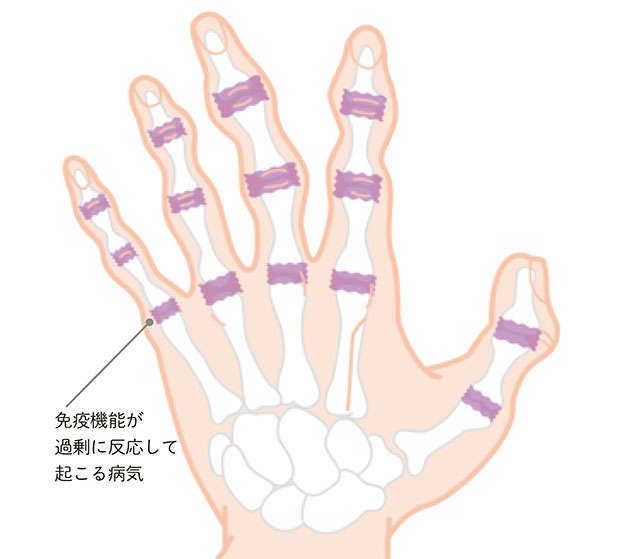 手指が痛む...おもな症状と特徴をチェックして、あなたの「病気」を特定しよう P049_01.jpg