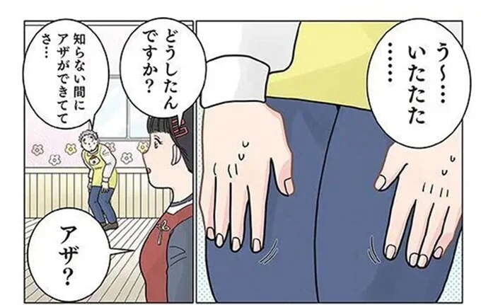 保育士の足にいつの間にかできたアザ。太ももに4カ所も...その「原因」は／保育士でこ先生4