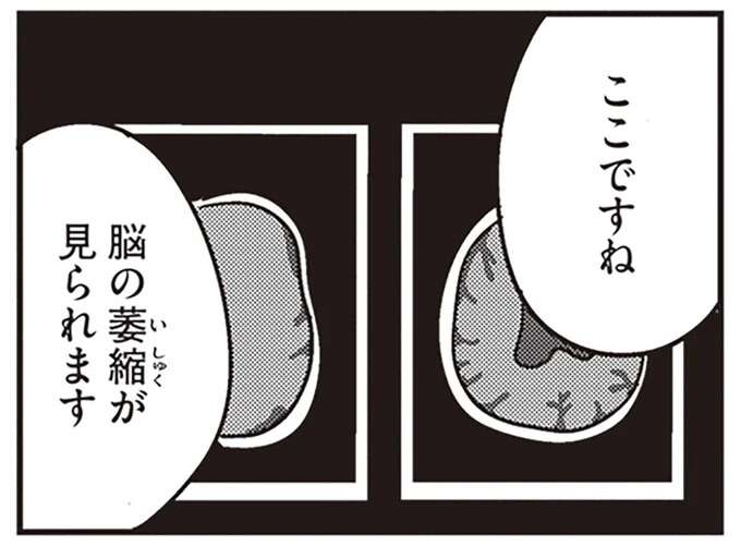 「脳の萎縮が見られます」医師が無表情で伝えた診断は「若年性認知症」。夫はまだ40代なのに...／夫がわたしを忘れる日まで